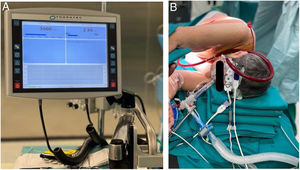 A. Progamación de los parámetros del ECMO V-V en uno de los casos. B. Colocación del paciente en decúbito lateral izquierdo con el ECMO V-V funcionante (se obtuvo consentimiento del paciente para la obtención de la fotografía).