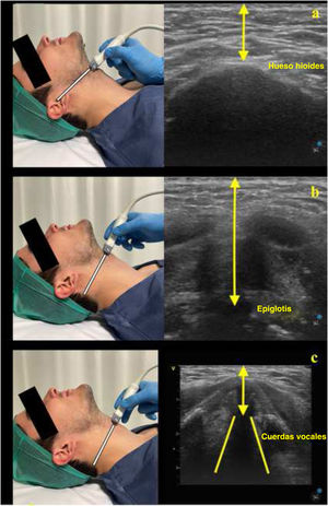 Medidas ecográficas de la piel-hueso hioides (a), piel-epiglotis (b) y piel-cuerdas vocales (c).