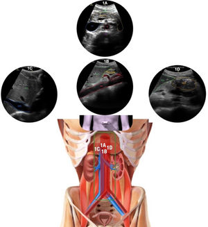 Zona central 1 del protocolo Ultrasound For Occult Haemorrhage (UFOH). Estación 1A: se observa la aorta (Ao) y la vena cava inferior (IVC; del inglés inferior vena cava) en la sección epigrástrica transversal, frente a una vértebra lumbar (LV; del inglés lumbar vertebrae) y tras el páncreas bajo el lóbulo hepático izquierdo (LLL; del inglés left lower lobe) como parte del retroperitoneo (clip 1A). Estación 1B: se observa la Ao en una sección sagital en el nivel epigástrico, con sus ramas principales (tronco celíaco [CT; del inglés celiac trunk]) y arteria mesentérica superior (SMA; del inglés superior mesenteric artery), y bajo el lóbulo hepático izquierdo (LLL) y la cabeza del páncreas en el medio (clip 1B). Estación 1C: se observa la IVC en la sección epigástrica sagital. Esta imagen se obtiene moviendo el transductor unos pocos centímetros hacia la derecha del paciente desde la estación 1B (clip 1C). Estación 1D: se observa el antro gástrico (GA; del inglés gastric antrum) en un eje circular corto, muy próximo al LLL, en la sección epigástrica sagital moviendo el transductor hacia la izquierda del paciente desde la estación 1A (clip 1D).