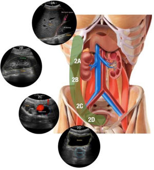 Zona derecha 2 del protocolo Ultrasound For Occult Haemorrhage (UFOH). Estación 2A: se observan el diafragma derecho, el lóbulo hepático derecho (RLL; del inglés right liver lobe), una porción superior del riñón derecho (RK; del inglés right kidney) y el músculo posas ipsilateral en una sección sagital-oblicua del hipocondrio derecho (clip 2A). Estación 2B: se observa la porción inferior del riñón derecho (RK), que reposa en la región medial del músculo psoas ipsilateral en un corte sagital oblicuo de la zona del costado derecho (clip 2B). Estación 2C: se observan los vasos iliacos (rojo y azul) que descansan sobre el músculo iliopsoas en una sección oblicua transversa del hipocondrio derecho. La línea hiperecogénica pertenece al hueso iliaco. Se debe optimizar la imagen comprimiendo el transductor en profundidad para desplazar el aire en el ciego que debe encontrarse en medio (clip 3B). Estación 2D: se observan la vejiga y la próstata en una sección transversa del hipogastrio (clip 2D).