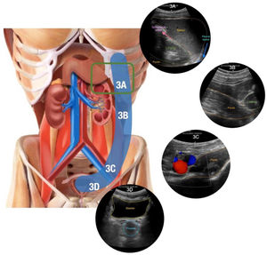 Zona izquierda 3 del protocolo Ultrasound For Occult Haemorrhage (UFOH). Estación 3A: se observan el diafragma izquierdo, el bazo y el riñón ipsilateral en esta porción superior (riñón izquierdo) en una sección coronal, pudiendo también observarse la parte proximal del músculo psoas izquierdo (clip 3A). Estación 3B: se observan el polo inferior del riñón izquierdo y una gran parte del músculo psoas proximal en el que se apoya (clip 3B). Estación 3C: se observan los vasos iliacos (rojo y azul) que descansan sobre el músculo iliopsoas en una sección oblicua transversa del hipocondrio izquierdo, de manera similar a la estación contralateral (2C). La línea hiperecogénica posterior al músculo pertenece al hueso iliaco. Estación 3D: se observan la vejiga y la próstata en una sección transversa del hipogastrio (clip 3D).