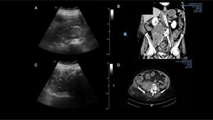 Ecografía y TAC que muestran un gran hematoma en el músculo iliopsoas derecho. A: zona 2 de la estación 2B del protocolo Ultrasound For Occult Haemorrhage (UFOH), plano sagital (clip 4A). Se observa ecográficamente un gran hematoma en el músculo iliopsoas derecho siguiendo la estación 2B del protocolo UFOH. (*) Obsérvese la imagen no estructurada y heterogénea del músculo psoas en su porción anterior. B: se confirma un gran hematoma en el músculo iliopsoas derecho, con sangrado activo, en la sección coronal de la angiotomografía computarizada (ATC) (*). C: zona derecha 2 de la estación 2B del protocolo UFOH (plano transversal del costado derecho) (clip 4B). Se observa ecográficamente un gran hematoma en el músculo iliopsoas derecho. D: se confirma la presencia de un gran hematoma en el músculo iliopsoas derecho en la sección transversal de la ATC.