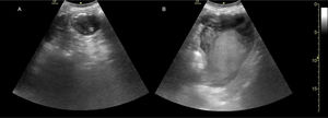 Zona central 1, estación 1D (plano de vista sagital o longitudinal) del protocolo Ultrasound For Occult Haemorrhage (UFOH). Transductor marcando las 11 en punto. A: Se observa un contenido heterogéneo en la vista del antro gástrico (*) (ver clip 5A). Es compatible con sangre o coágulo en un paciente que desarrolló sangrado gastrointestinal secundario al uso de antiinflamatorios no esteroides (AINE). LLL: lóbulo izquierdo del hígado. B: Se observa sangre o coágulos (*) en el fundas gástrico en una vista oblicua subcostal (ver clip 5B).