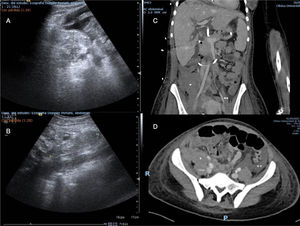 Zona derecha 2, estaciones 2B y 2C (plano de visión sagital y transversal) del protocolo Ultrasound For Occult Haemorrhage (UFOH) y angiotomografía computarizada (ATC) que muestra hematoma en el músculo psoas. A: zona derecha 2 (estación 2C) en una sección oblicua transversa del protocolo UFOH. Se observó hematoma de 18,2mm anterior al músculo psoas y ascitis hemorrágicas en una paciente con trasplante de hígado (clips 6B, 6C y 6D). B: zona derecha 2 (estación 2B) del protocolo UFOH (plano sagital). Se observa hematoma en el músculo psoas en una paciente con trasplante hepático. Obsérvese la imagen ovoide en la porción anterior del músculo psoas de 93,6mm (clip 6A). C: la presencia de un hematoma en el músculo psoas (*) que comprime parte de la arteria iliaca común, en un plano coronal, se confirma mediante ATC. D: la presencia de un hematoma en el músculo psoas (*) y ascitis (**) se confirma mediante ATC.