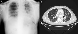 A) Rx de tórax. B) TC de tórax. Parénquima pulmonar con patrón de enfisema centrilobulillar y paraseptal. Patrón alveolar parcheado bilateral de predominio izquierdo.