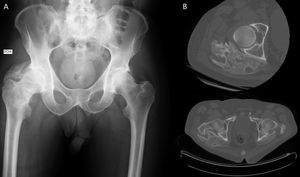A) Rx de cadera. B) TC de cadera. El paciente tenía OH en la cadera derecha con osificación periarticular intramuscular en el cuadrado femoral, porción profunda del músculo glúteo medio y menor, piramidal y obturador interno.