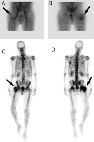 A y B) Gammagrafía ósea con [99mTc]Tc-MDP en fase precoz de caderas. C y D) Fase tardía de cuerpo completo. Demostraron OH metabólicamente activa con signos inflamatorios agudos asociados en partes blandas de la cadera derecha (flechas) y en menor grado en la cadera izquierda. En la etapa inicial (2-4 semanas), la gammagrafía ósea es más sensible que la radiografía simple para detectar OH, mientras que la TC permite una mejor visualización del hueso heterotópico y permite mejor planear la cirugía.