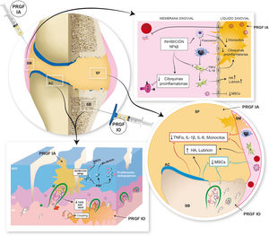 Una nueva aproximación al tratamiento de la artrosis de rodilla mediante la combinación de inyecciones intraarticulares e intraóseas de PRGF. Fuente: tomado de Sanchez el al. [10].