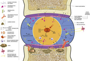 Los posibles mecanismos moleculares implicados en la inflamación de baja intensidad en la articulación intervertebral y la comunicación entre el disco vertebral y el hueso subcondral vertebral. Fuente: tomado de Anitua et al. [12].
