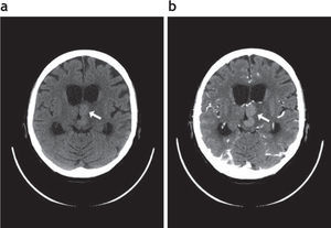 Linfoma primario del sistema nervioso central en un paciente inmunodeprimido, cuya lesión se localiza en el tálamo izquierdo y el tercer ventrículo (fl echa blanca). (a) Es hiperdensa en la tomografía computada sin contraste. (b) Realza homogéneamente poscontraste.