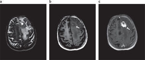 Afectación del lóbulo frontal izquierdo por linfoma primario del sistema nervioso central en un paciente inmunodeprimido. Se visualiza una lesión (fl echa blanca). (a) Hipointensa en ponderación T2. (b) Isointensa en secuencia ponderada en T1, que (c) realza intensamente tras la administración de contraste.