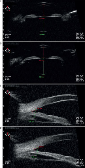 Paciente Grupo 1. Ultrabiomicrocopía. (a) En visión lejana. (b) En visión cercana. (c) Distancia desde la córnea hasta el cuerpo ciliar en visión lejana. (d) Distancia desde la córnea hasta el cuerpo ciliar en visión cercana.