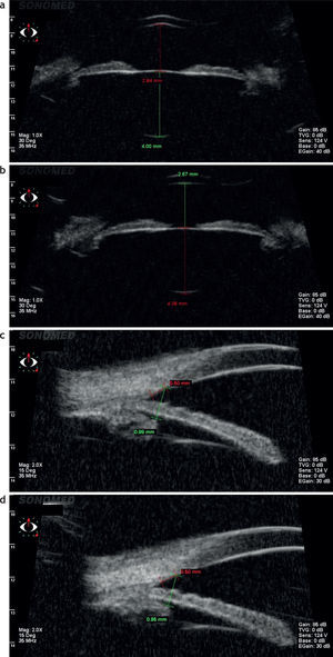 Paciente Grupo 2. Ultrabiomicroscopía. (a) En visión lejana. (b) En visión cercana. (c) Distancia desde la córnea hasta el cuerpo ciliar en visión lejana. (d) Distancia desde la córnea hasta el cuerpo ciliar en visión cercana.