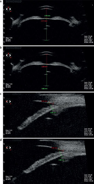 Paciente Grupo 2. Ultrabiomicroscopía. (a) En visión lejana. (b) En visión cercana. (c) Distancia desde la córnea hasta el cuerpo ciliar en visión lejana. (d) Distancia desde la córnea hasta el cuerpo ciliar en visión cercana.