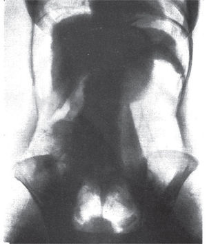 Neumoperitoneo diagnóstico normal. Se muestran los órganos abdominales delineados por aire21.