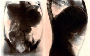 Neumoperitoneo diagnóstico de un caso de hidatidosis abdominal21.