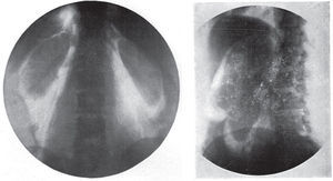 Neumoretroperitoneo diagnóstico. A la izquierda se observa un estudio normal y a la derecha, un quiste renal26.