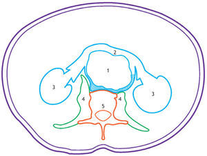 Dibujo esquemático correspondiente a la tomografía computada de la figura 1. Se puede observar la imagen correspondiente al signo del abrazo aórtico, identificada con líneas oblicuas paralelas (1: aorta, 2: retroperitoneo, 3: sombras renales, 4: músculos psoas y 5: columna vertebral).