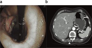 (a) Gastroscopia: se observa una masa ulcerada dependiente de la pared gástrica. (b) Corte axial de tomografía computada: se evidencia una lesión sólida hiperdensa en la curvatura mayor del estómago que se proyecta a la luz gástrica (flecha blanca). También se aprecia un implante en la musculatura retrosomática (punta de flecha).