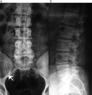 Radiografía de columna lumbosacra de (a) frente y (b) perfil: se observa en el hueso ilíaco derecho una lesión osteolítica (flecha) expansiva, bien definida y de bordes finamente esclerosos, que se visualiza mejor en la proyección de frente.