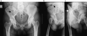 Radiografía de pelvis en proyección (a) de frente, (b) alar y (c) obturatriz: se corrobora la lesión osteolítica (flechas) en el hueso ilíaco derecho.