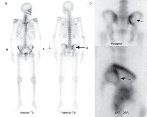Gammagrafía ósea con 99m Tc-MDP: (a) cuerpo entero e (b) imágenes planares. Se observa en el hueso ilíaco derecho una imagen hipocaptante ovalada (flechas) con márgenes hipercaptantes.