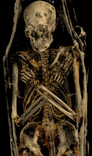 Reconstrucción tridimensional con ventana ósea de la momia masculina: se observan los brazos cruzados sobre el pecho (posición de Osiris) y múltiples lesiones líticas en la calota.