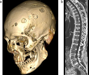 (a) Reconstrucción ósea tridimensional de la calota y el maxilar, vista parasagital, evidencia múltiples lesiones líticas. (b) Vista sagital de la columna dorsolumbar con ventana ósea muestra acuñamiento anterior de la 7.a vértebra dorsal.