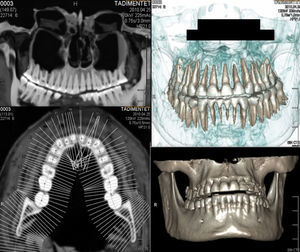 Examen con protocolo escáner dental y reconstrucción tridimensional de ambos maxilares de la momia femenina: hay indemnidad de las piezas y raíces dentales.