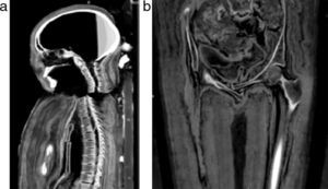 Tomografía computada multicorte. (a) Vista sagital: desarticulación del esternón y desalineación de la columna cervical. (b) Vista coronal de la región pelviana con cabalgamiento de los huesos pubianos.