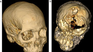 (a y b) Reconstrucciones óseas tridimensionales del cráneo del paquete funerario: se observa ausencia occipital parcial y material denso irregular dentro de la calota.