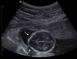 Ecografía obstétrica de un feto de 18 semanas. En el corte axial del cráneo, a la altura de los ventrículos laterales, se observa una impronta bifrontal: signo del limón (flechas).