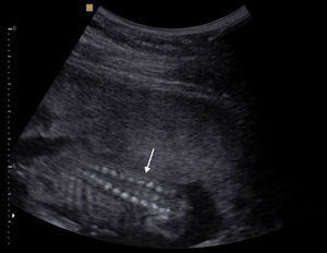 Ecografía obstétrica de un feto de 18 semanas. El corte coronal de la columna lumbar muestra separación de los pedículos vertebrales: espina bífida (flecha).