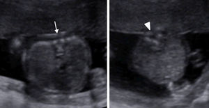 Ecografía obstétrica de un feto de 18 semanas. Los dos cortes axiales comparativos marcan la diferencia entre la separación peduncular a nivel torácico (flecha) y lumbar (punta de flecha).