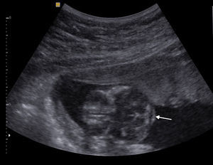 Ecografía obstétrica de un feto de 18 semanas. El corte suboccipital evidencia abombamiento anterior del cerebelo y falta de visualización de la cisterna magna (flecha).