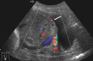 Caso 6: ecografía con Doppler color, corte sagital, que demuestra la hipervascularización de la interfase uterino-vesical y pared vesical (flecha). Confirmación histológica de compromiso vesical.