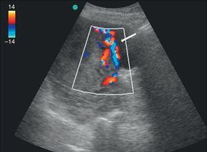 Caso 3: ecografía con Doppler color, corte sagital, que demuestra la hipervascularización de la interfase uterino-vesical y pared vesical (flecha). Confirmación histológica de compromiso vesical.