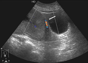 Caso 16: ecografía con Doppler color que demuestra la vascularización habitual de la base placentaria, sin vascularización de la interfase (flecha). Confirmación histológica de acretismo sin afectación vesical.