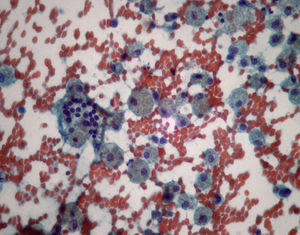 Numerosos macrófagos y un colgajo central de células foliculares típicas. Nódulo coloideo - Bethesda II.