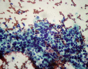 Colgajo de células epiteliales oxifílicas en íntima relación con linfocitos de pequeño tamaño. Tiroiditis de Hashimoto - Bethesda II.