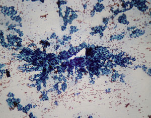 Patrón monótono de células epiteliales en microfolículos. Bethesda IV.