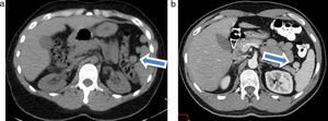 Tomografía computada de abdomen en corte axial (a) sin contraste: se observan múltiples bazos accesorios (flecha); (b) con contraste: se evidencia un bazo accesorio adyacente al hilio esplénico (flecha).