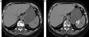 (a y b) Tomografía computada de abdomen sin contraste: se observa una lesión focal esplénica con densidad grasa, compatible con lipoma (flecha en b).