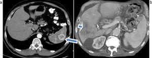 (a) Lesión focal hipervascular esplénica: metástasis de melanoma (flecha). (b) Lesiones hipodensas en el bazo y el hígado con presencia de ascitis: metástasis de colon (flecha).
