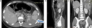 (a-c) En la tomografía computada multidetector se observan lesiones traumáticas esplénicas (laceración y rotura) con un importante hematoma periesplénico (flecha en a).