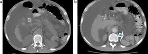 (a y b) Paciente con signos de hepatopatía crónica y ascitis, y antecedentes de esplenectomía por traumatismo. Se notan múltiples lesiones redondeadas con densidad de partes blandas, adyacentes al páncreas y riñón izquierdo, compatibles con esplenosis (flecha en b).