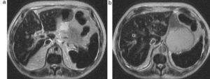 (a y b) Resonancia magnética ponderada en T2 con hipointensidad difusa del bazo y el hígado: hemocromatosis.