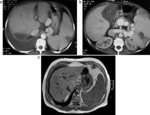 (a y b) Tomografía computada de abdomen con contraste oral y endovenoso: se observan múltiples colaterales portales con esplenomegalia y lesiones hipodensas en el bazo, compatibles con infartos esplénicos, ascitis, signos de hepatopatía crónica y derrame pleural derecho. (c) Resonancia magnética: se visualizan cuerpos de Gamma-Gandy en un paciente masculino de 55 años de edad con hígado cirrótico y esplenomegalia. A nivel del bazo, se evidencian múltiples lesiones pequeñas hipointensas en ponderación T1 en fase, compatibles con nódulos sideróticos.