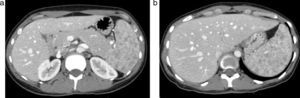 (a y b) Paciente con diagnóstico de sarcoidosis con compromiso esplénico: se observan múltiples imágenes hipodensas que no refuerzan con contraste y que infiltran el bazo.