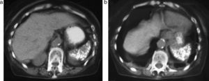 (a y b) Bazo disminuido de tamaño con múltiples calcificaciones en un paciente con anemia de células falciformes.